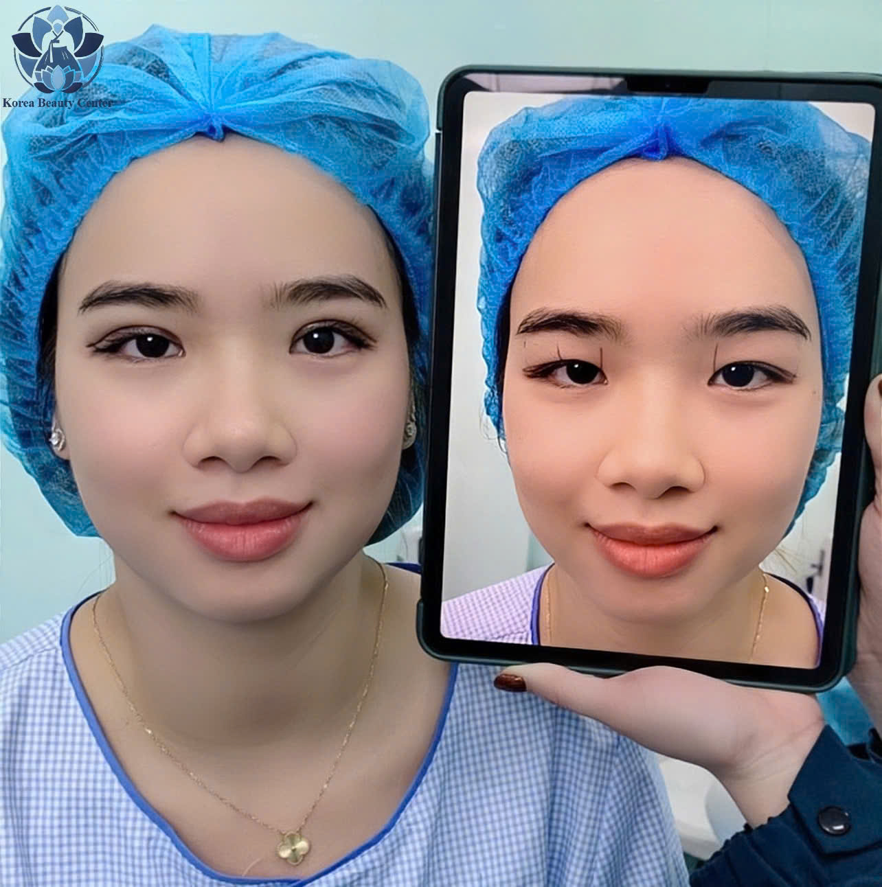 Cân chỉnh mí mắt