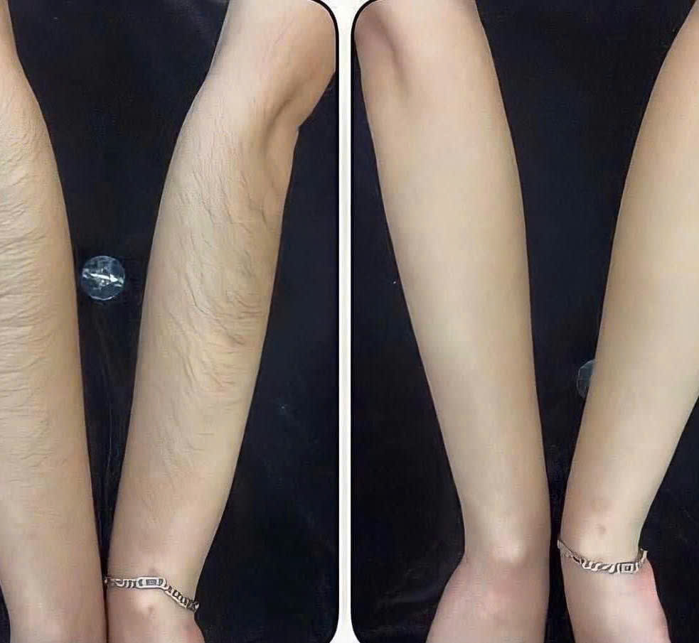 Triệt lông cánh tay